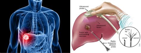 liver cancer near roseville|Liver cancer .